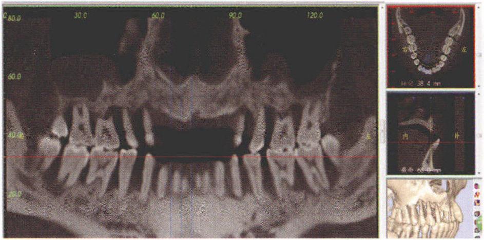 数字化种植外科导板在短牙弓整体桥种植修复病例中的应用